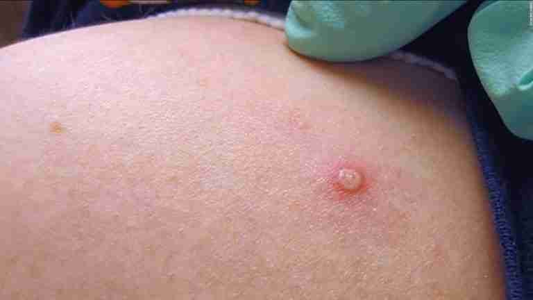 No es ‘Viruela del Mono’, es MPox