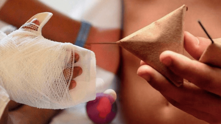 Aumenta la cifra de quemados por pólvora en Antioquia
