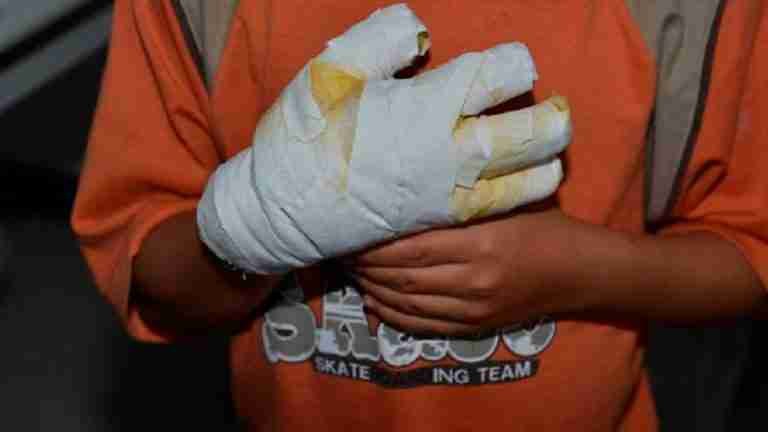 97 quemados dejó la celebración decembrina y fin de año en Antioquia