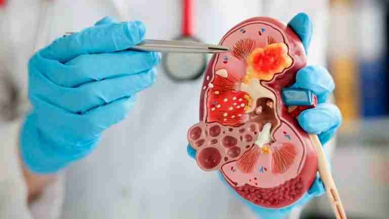 1 de cada 10 personas en el mundo padecen una enfermedad renal