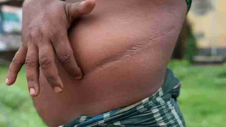 Bajo falsas promesas de calidad de vida, un hombre casi pierde un órgano