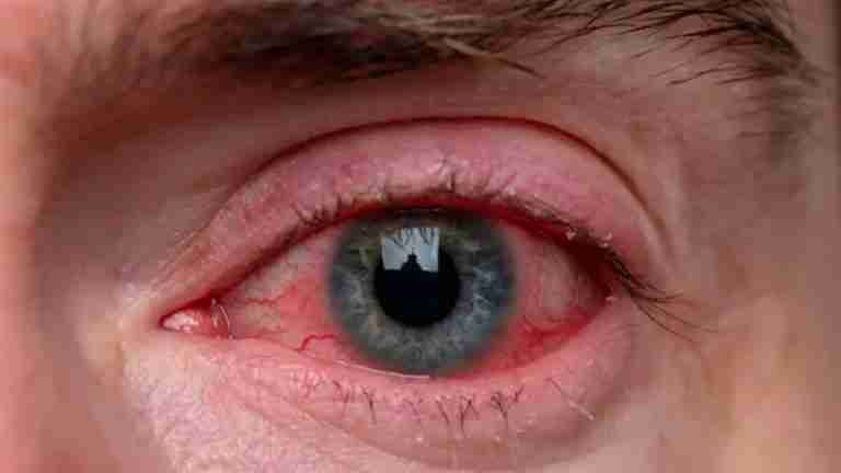 Hombre colombiano muere tras acudir al hospital por una partícula en el ojo