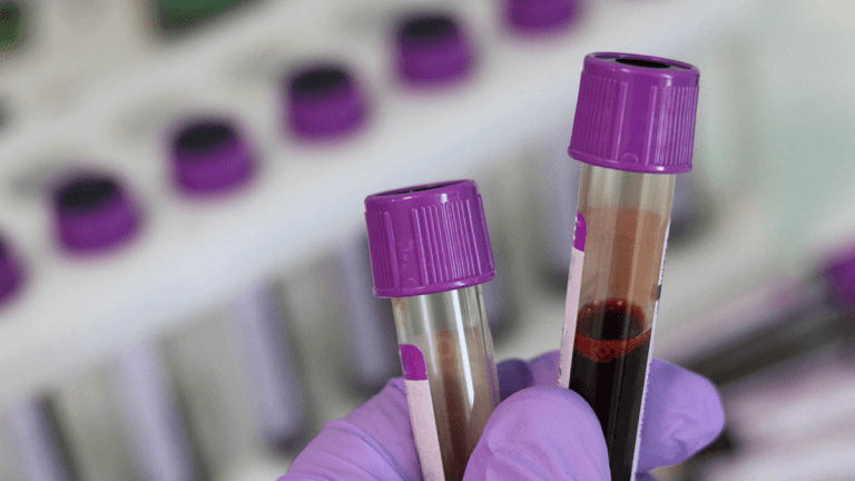 Buen progreso: examen de sangre ayudará a detectar diferentes tipos de cáncer 