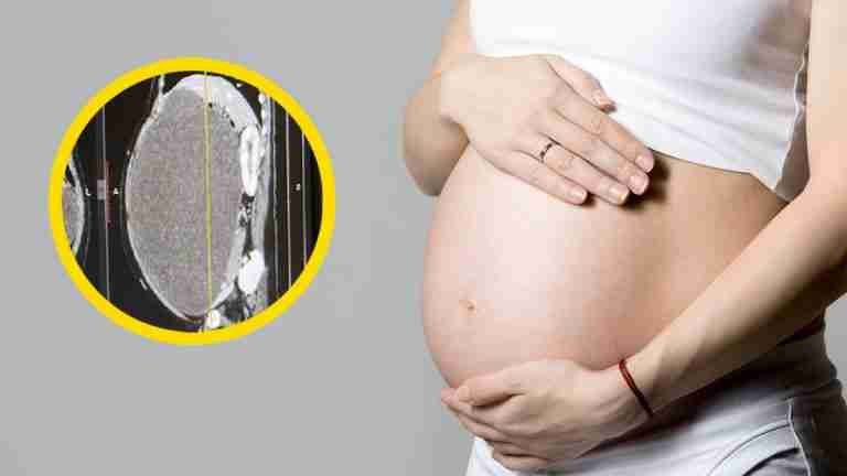 Colombiana confunde tumor con embarazo y es sometida a cirugía para salvar su vida 