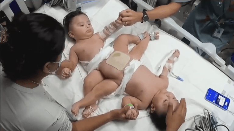 Gemelos siameses regresan a casa separados tras exitosa cirugía