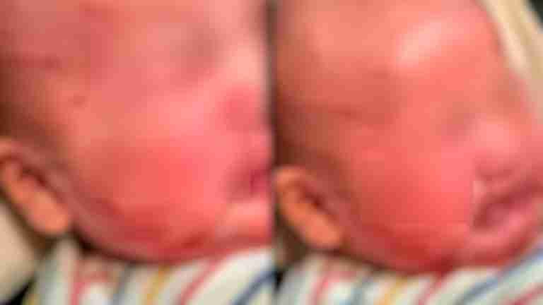 Acusaciones de abuso infantil en guardería tras hallazgo de bebé con numerosos rasguños en el rostro