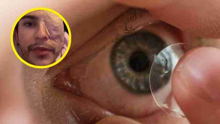 Por un mal uso de los lentes de contacto, un joven pierde su ojo