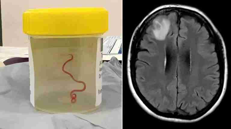 Hallan gusano vivo en el cerebro de una mujer australiana