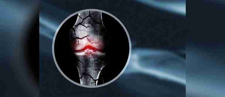20 de octubre: Día Mundial de la Osteoporosis