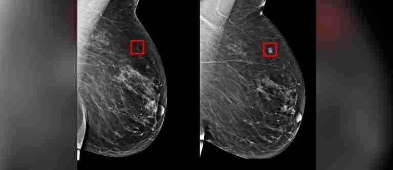 Inteligencia artificial podría detectar el cáncer de mama 5 años antes de que se desarrolle