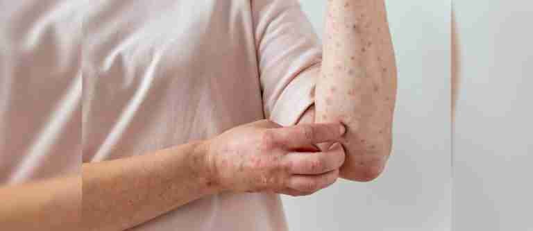 OMS alerta sobre brotes de sarampión en Europa
