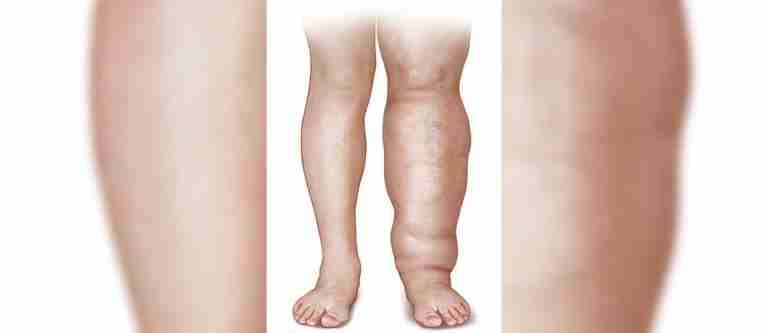6 de marzo: Día Internacional del Linfedema