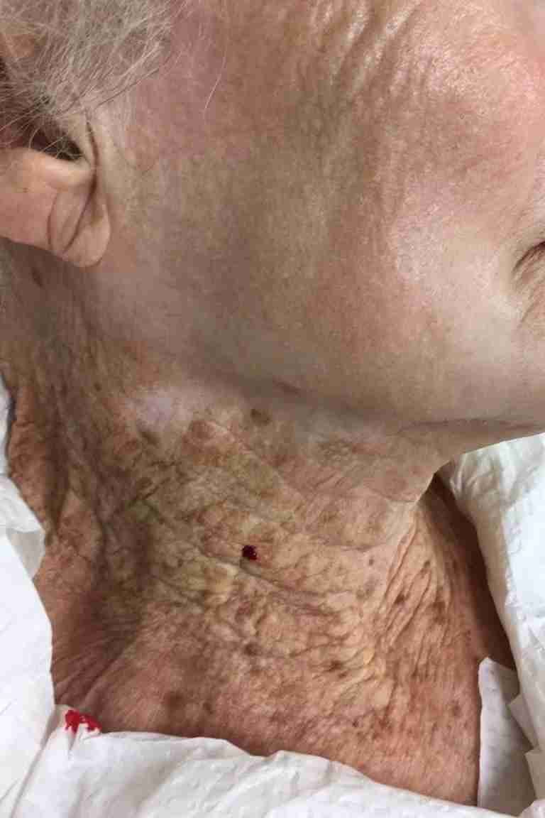 Alerta en Colombia por aumento de casos de cáncer de piel