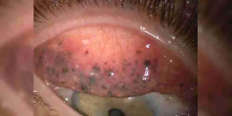 Durante 25 años una mujer estuvo sin retirar adecuadamente la pestañina de sus ojos y este fue el resultado