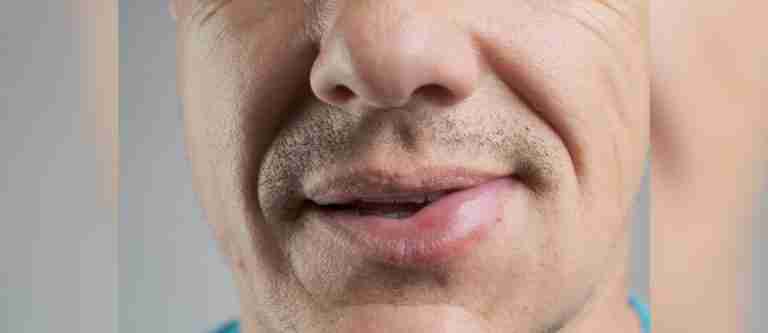 16 de mayo: Día Mundial del Angioedema Hereditario
