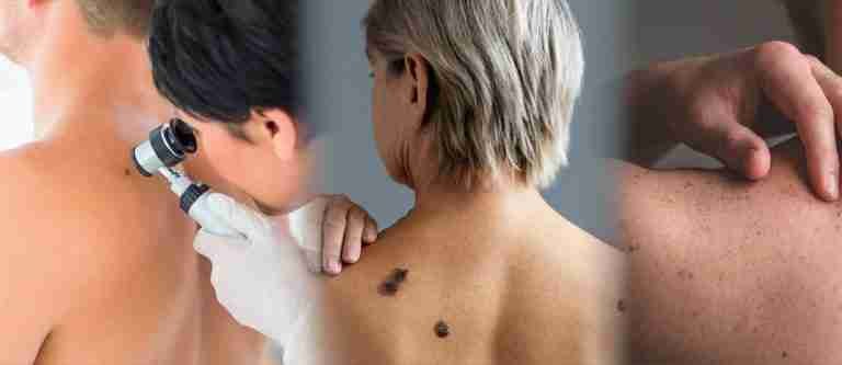 23 de mayo: Día Mundial contra el Melanoma