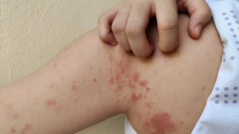 La OMS reconoce las enfermedades de la piel como urgencia sanitaria global