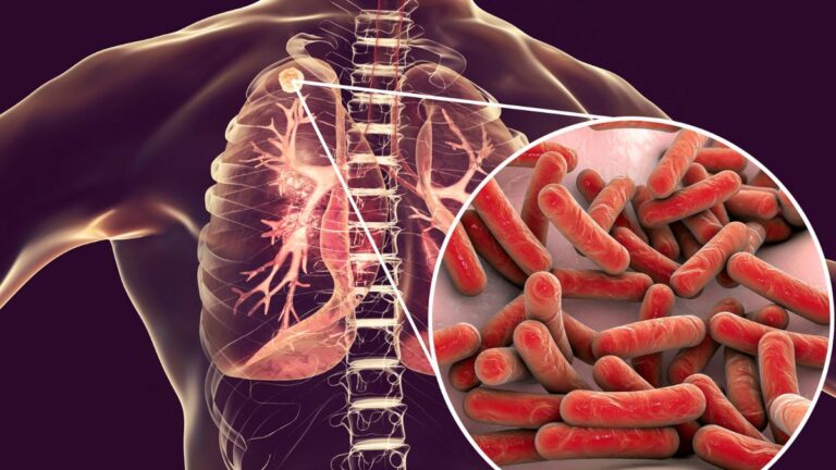 Refuerzo en atención contra tuberculosis