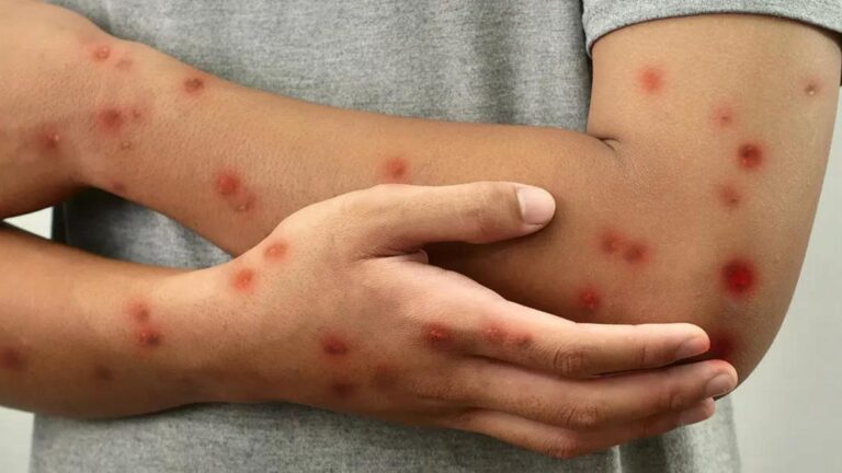 OMS levanta la emergencia sanitaria mundial por Mpox en África, pero advierte que el virus sigue siendo una amenaza