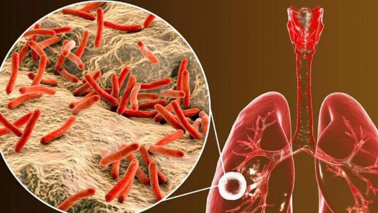 Corte Constitucional ordena acción inmediata por brote de tuberculosis en cárceles de Antioquia y Bucaramanga