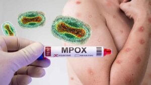 Confirman primer caso de mpox con variante clado Ib en Colombia
